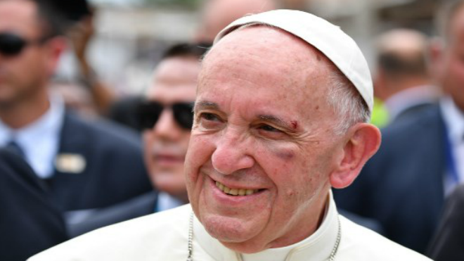 Papa Francisco sufrió un golpe en el rostro el cual fue tratado durante su visita a Colombia. Foto AFP