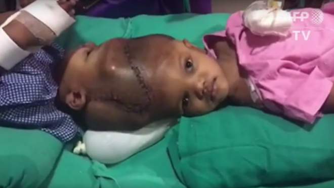 Con el trabajo de un equipo de 40 médicos, estos siameses nacidos en la India sobrevivieron a una cirugía de separación. Foto AFP TV