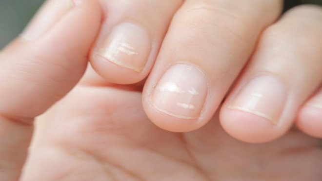 ¿Por qué aparecen manchas blancas en las uñas?