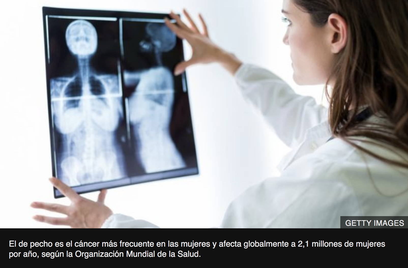 Qué es el cáncer de mama metastásico y cómo puedes reconocer sus síntomas: “Me sentía una hipocondríaca por ir al médico todo el tiempo”