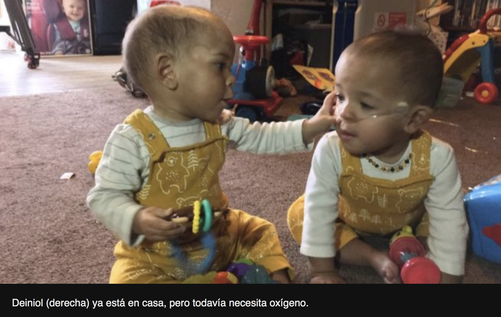 El bebé prematuro gravemente enfermo que mejoró en la incubadora luego del abrazo de su hermanito gemelo