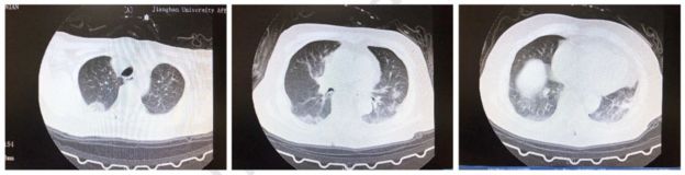  Los exámenes mostraban señales en los dos pulmones que pueden ser asociados a una neumonía. (Foto Guatevisión: BBC News Mundo)