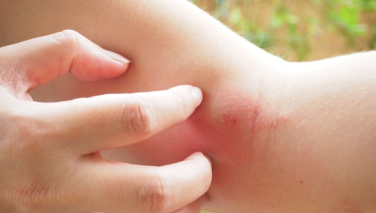 Tres niños querían los poderes del Hombre Araña y se dejaron picar por una viuda negra