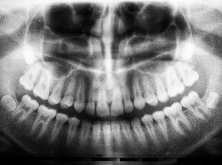 Cepillarse los dientes para mantener el cerebro libre de bacterias