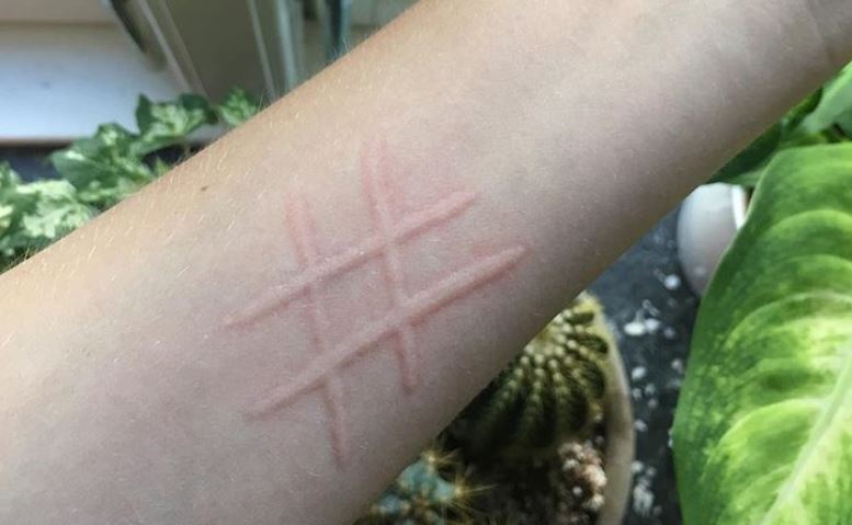 Entérese qué es la dermatografía y cómo una joven que la padece la utiliza para crear “tatuajes temporales”