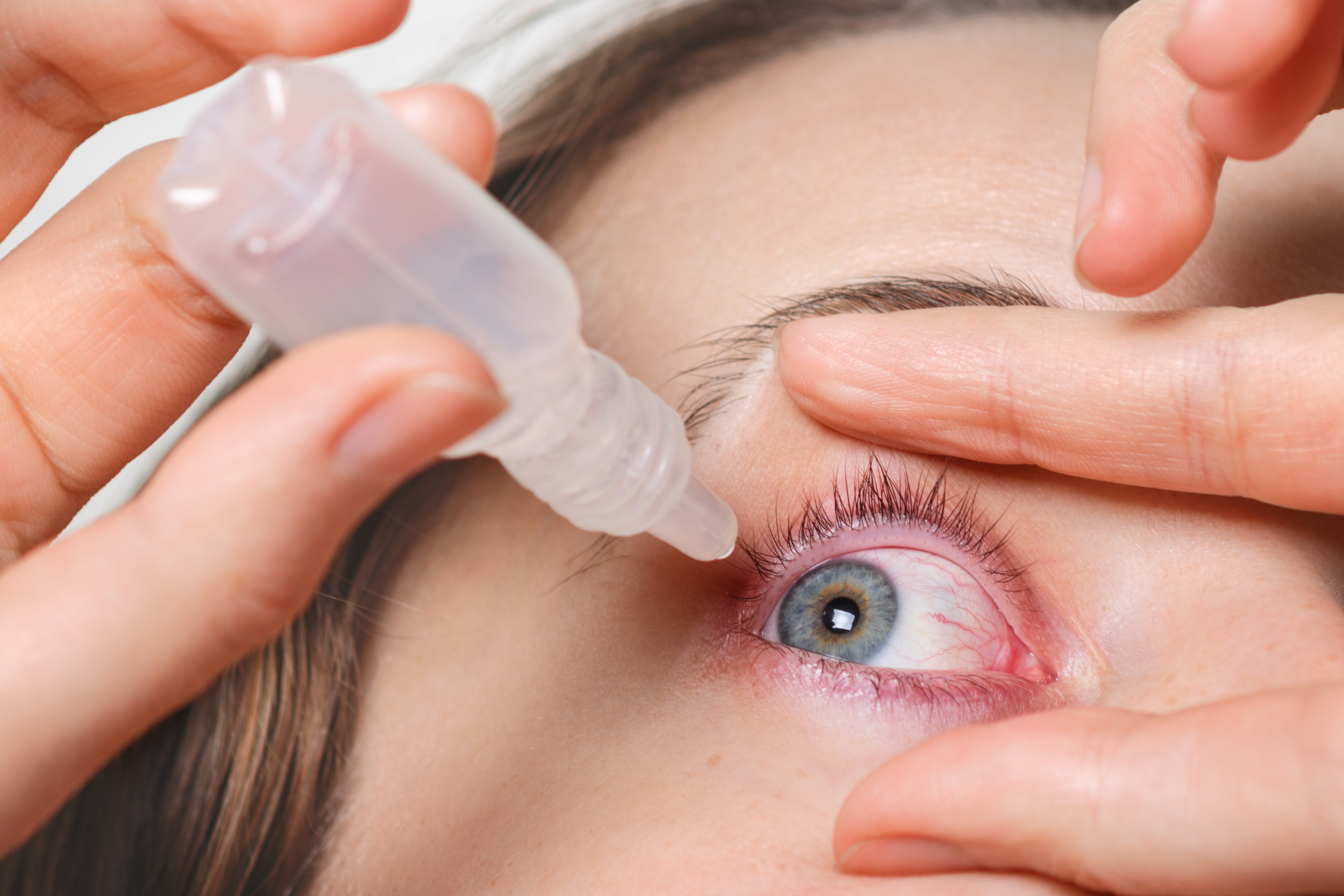 La conjuntivitis es el primer síntoma de detección del coronavirus, según un estudio español