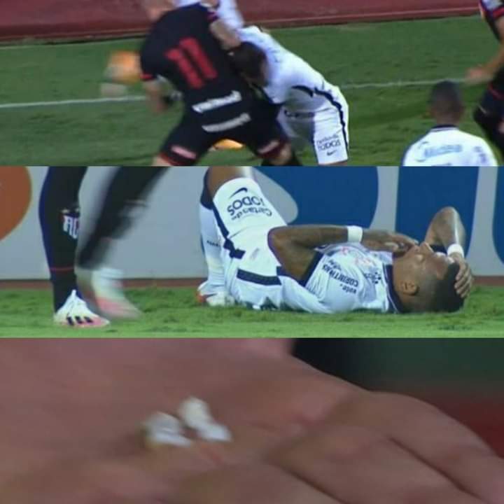 VIDEO: Futbolista pierde cuatro dientes durante un choque con un rival en Brasil