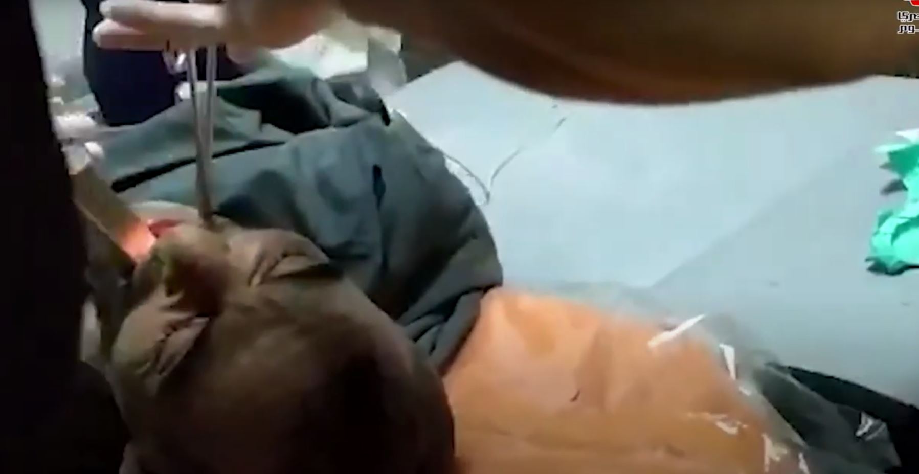 VIDEO: extraen un pez vivo de la tráquea de un hombre a quien se le introdujo por accidente