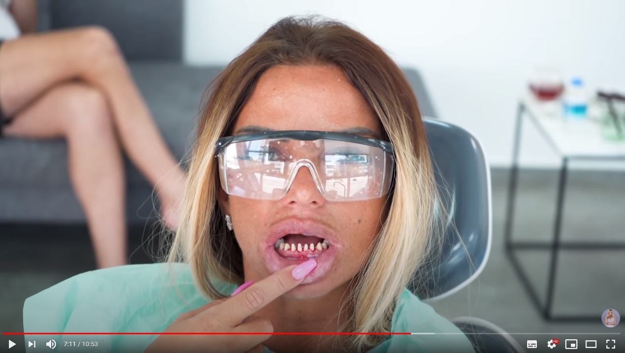 Por estética o “tendencia”, influencers se someten a tratamiento dental que preocupa a expertos