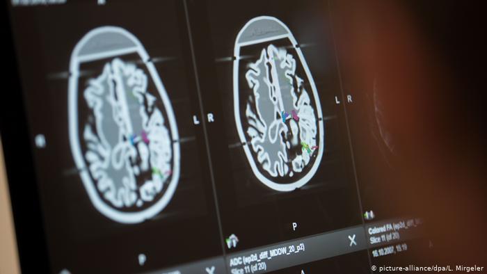 El coronavirus podría entrar en el cerebro a través de la nariz, según estudio