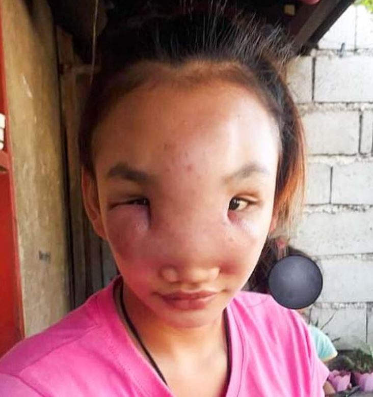 Joven se exprime una espinilla y le desfigura la cara