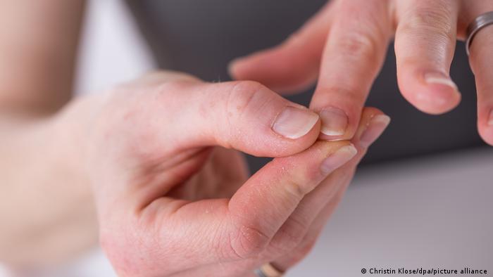 Surgen informes sobre “uñas COVID”: estos cambios podrían indicar infección pasada por coronavirus