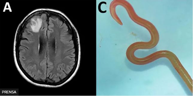 Un gusano vivo en el cerebro de una mujer y otras 4 noticias de salud que causaron impacto en 2023