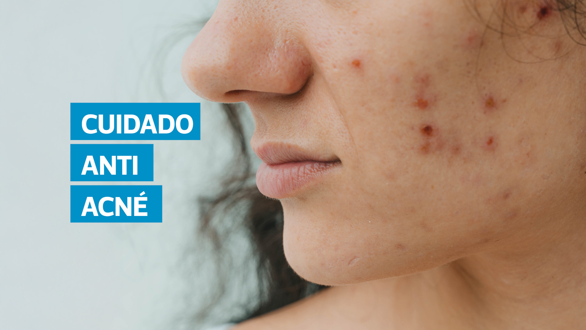 El acné es una afección dermatológica común que puede afectar la autoestima, en especial durante la adolescencia. De acuerdo con las dermatólogas Miriam Yat y Eva Oliva, aunque algunos tipos de acné son inevitables, existen tratamientos eficaces y cuidados preventivos que ayudan a controlar la enfermedad y evitar complicaciones a largo plazo.