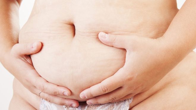 Tras las gestación y el parto los músculos abdominales se pueden quedar estirados, debilitados y separados. (GOKHANILGAZ / GETTY IMAGES)