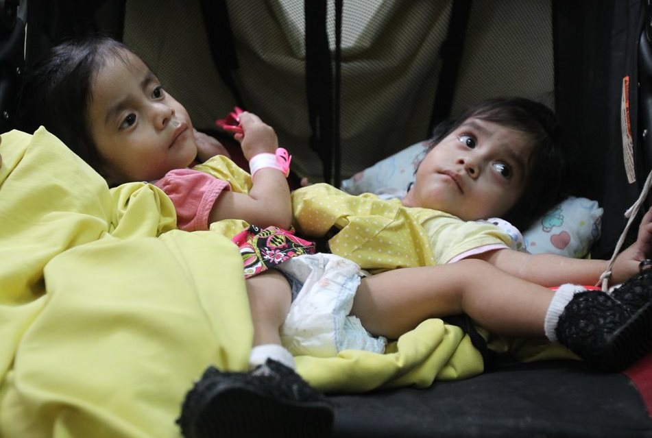 Rosa Linda y Ana Rosa, las siamesas conocidas como " Las Rositas" seran seraparadas el próximo martes. (Foto Prensa Libre: Esbin García)