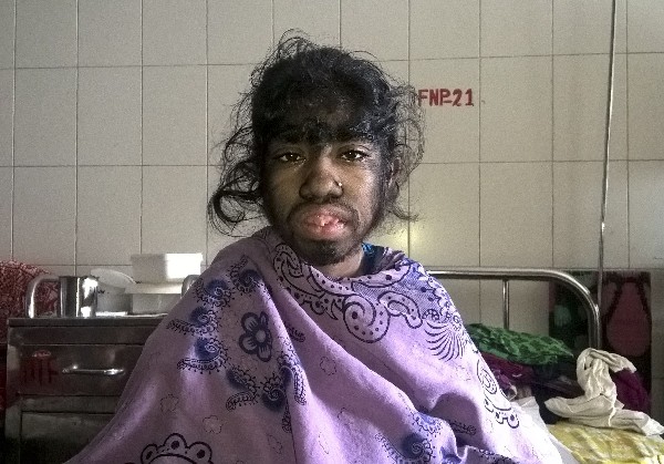 Bithi Akhtar padece del “síndrome del hombre lobo”. (AFP).