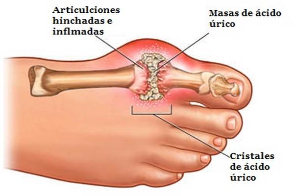 El exceso de ácido úrico afecta las articulaciones