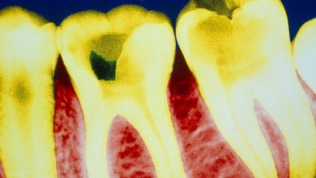 La caries está causada normalmente por la actividad de la placa bacteriana, que genera ácidos que dañan el esmalte de los dientes.