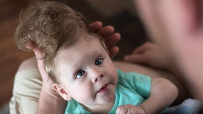 Los médicos les dijeron a los padres de Bentley que su hijo no sobreviviría. C. COHEN/HOSPITAL INFANTIL DE BOSTON.