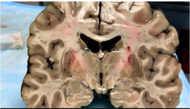 A pesar de su apariencia saludable exterior, el cerebro de Hernández estaba profundamente dañado por la encefalopatía traumática crónica. (Foto Prensa Libre: cortesía Boston University)