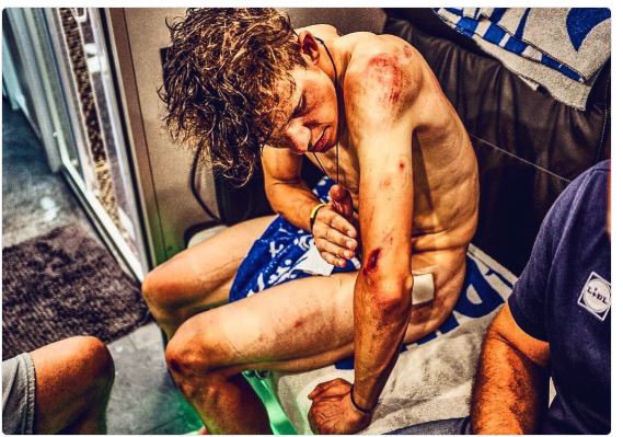 Bob Jungels sufrió una fuerte caída en la novena etapa del Tour de Francia. (Foto Instagram Jungels).