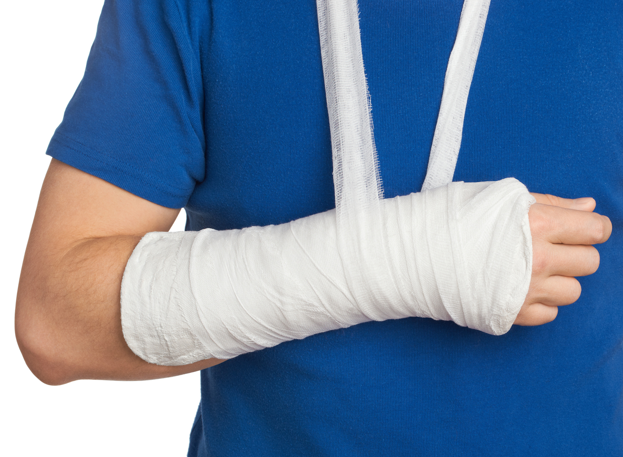 La recuperación de una fractura de brazo depende de la parte afectada, la edad y estado de salud del paciente.