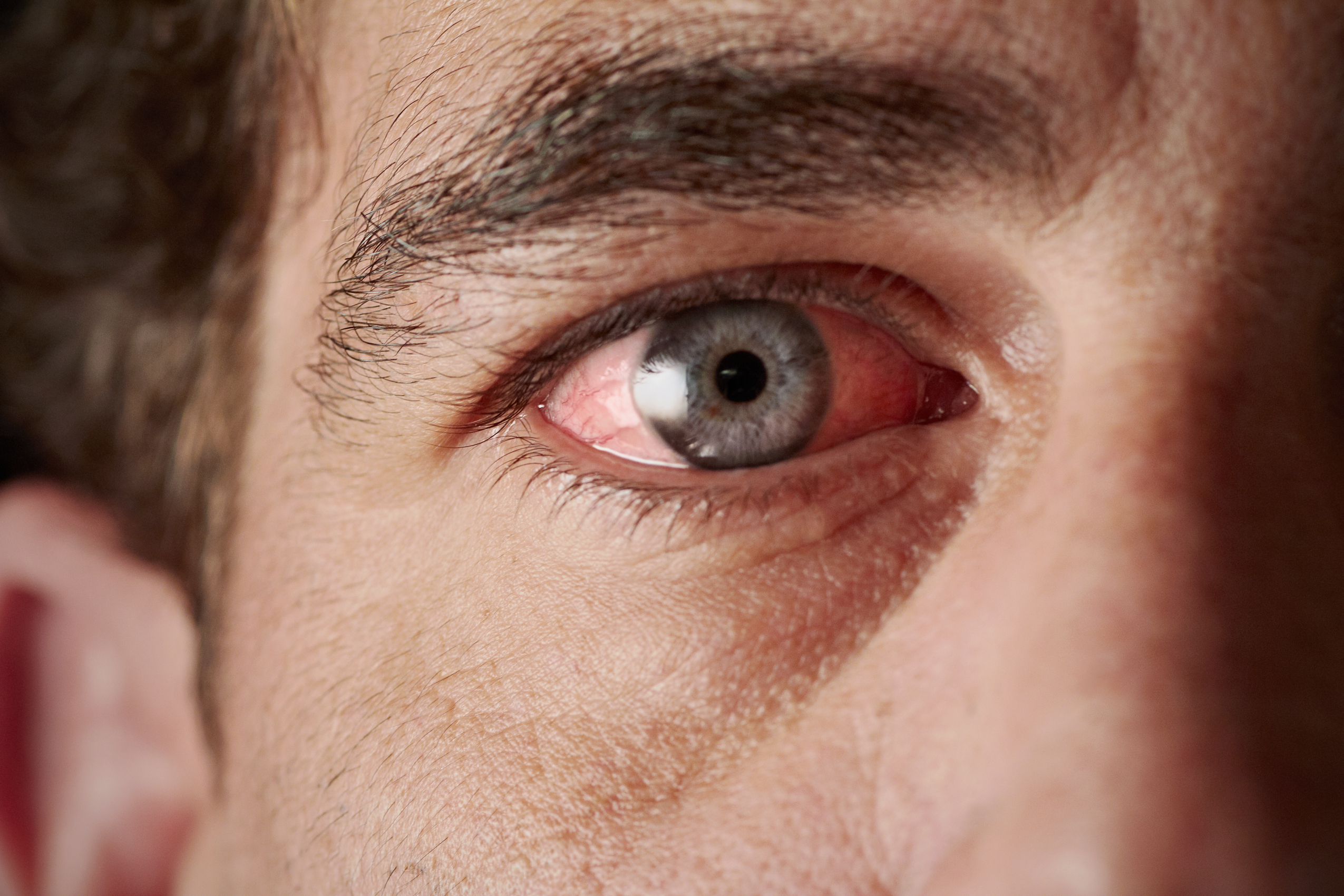 La uveítis es una enfermedad que consiste en la inflamación de la úvea, en los ojos. (Foto Prensa Libre: Servicios).