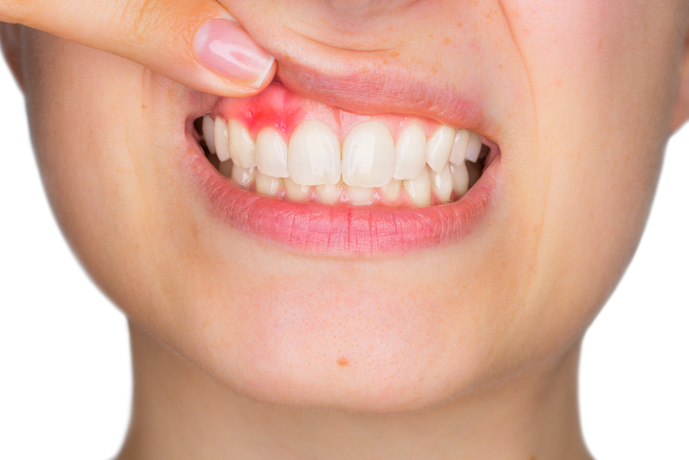 La gingivitis es una enfermedad que provoca inflamación y sangrado de las encías. Puede revertirse en cuestión de meses mejorando su higiene dental y con la ayuda de un profesional. (Foto Prensa Libre: Servicios)