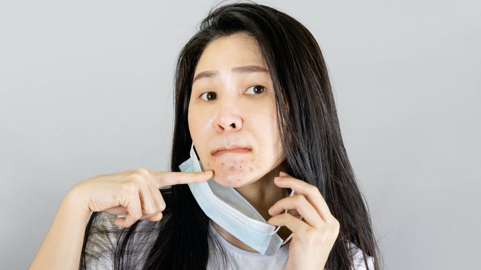 Son varios los especialistas que hablan del incremento de casos de acné por el uso continuado de la mascarilla. FOTO Getty Images