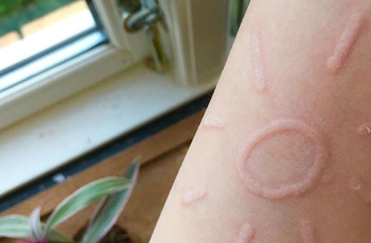 Emma Aldenryd quien padece dermatografía crea dibujos en su piel solo con frotarla. (Foto Prensa Libre: @dermatographia_)