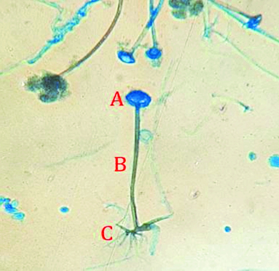 mucormicosis (hongo negro)