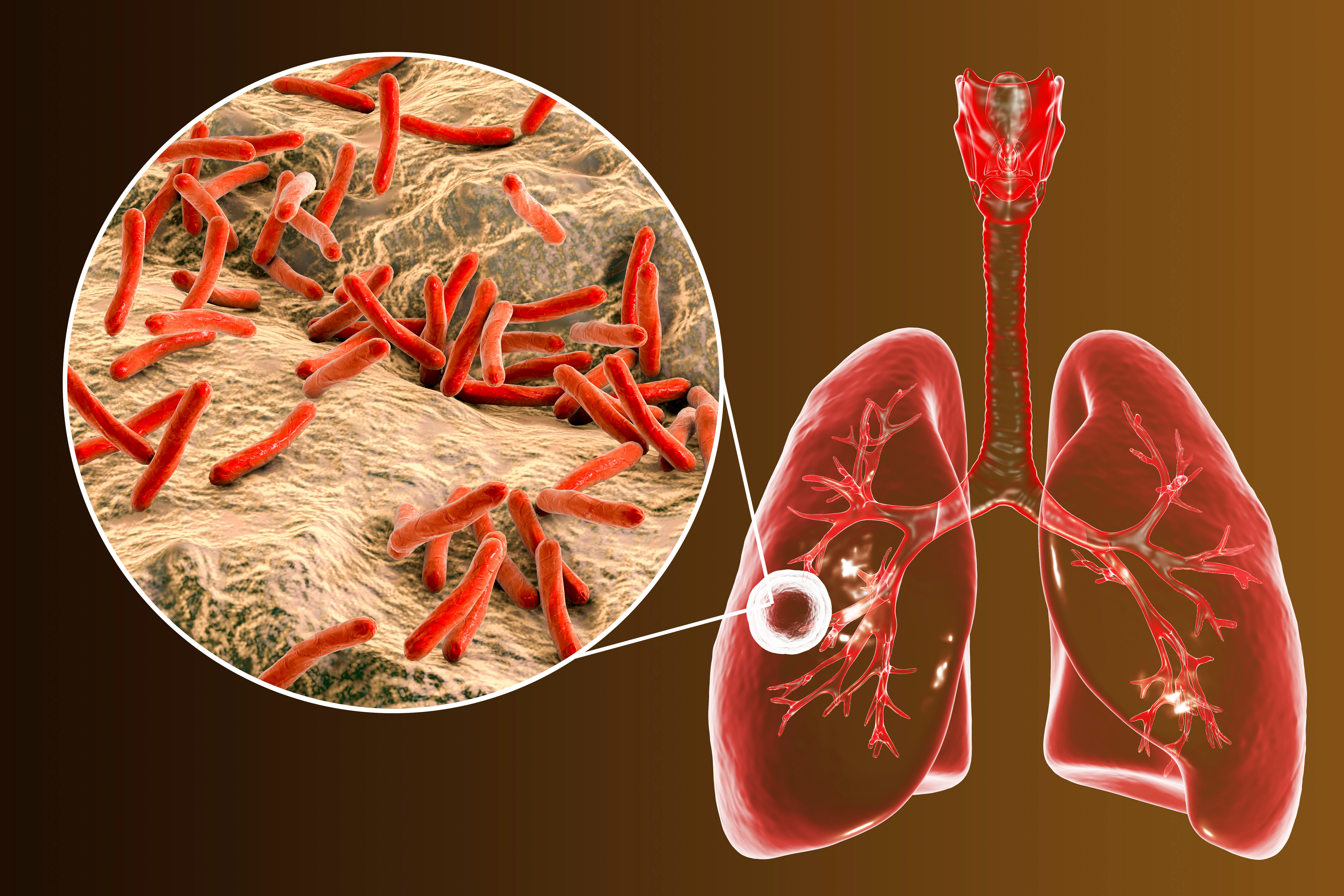 Datos sobre la tuberculosis