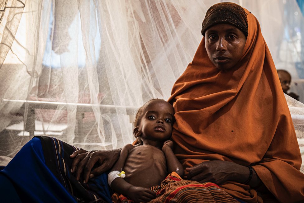 Muchos niños tienen graves problemas de salud debido a la falta de alimentos en Somalia.