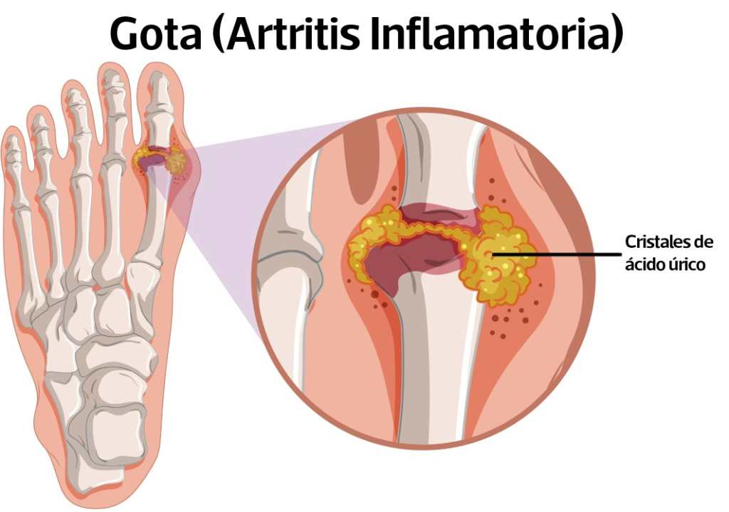 síntomas de gota