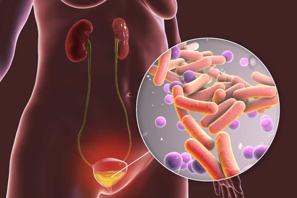 Cistitis - Infecciones Urinarias (1)