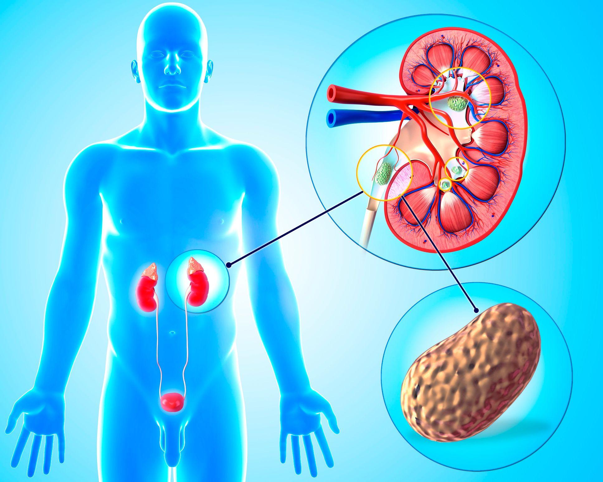 Una de cada 10 personas sufre de cálculos renales, que pueden obstruir el flujo de la orina por los uréteres.