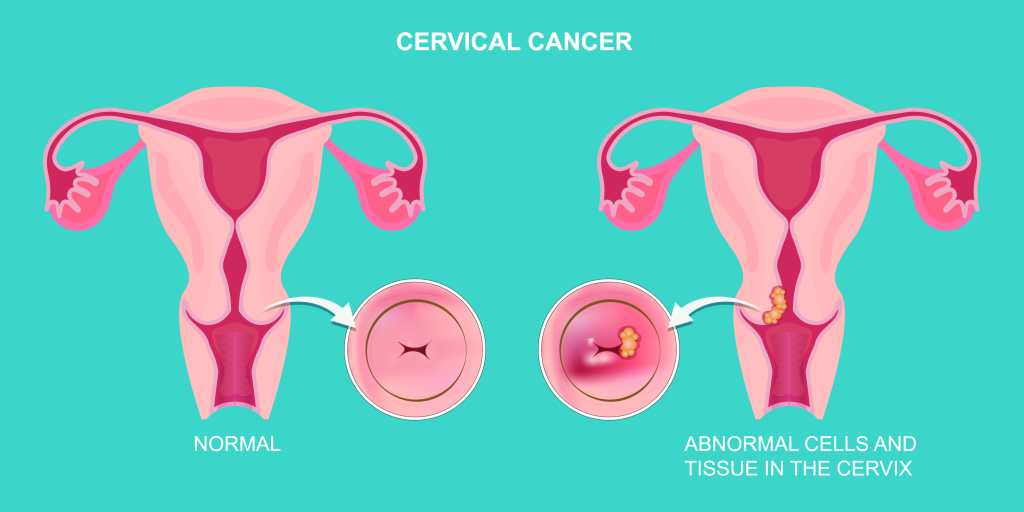 El cáncer de cuello uterino es un crecimiento de células que comienza en el cuello uterino. El cuello uterino es la parte inferior del útero que se conecta a la vagina. Atención médica y Ilustración vectorial.