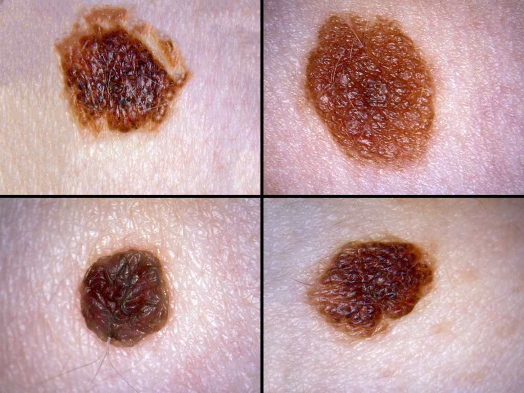 Color anormal del lunar sospechoso