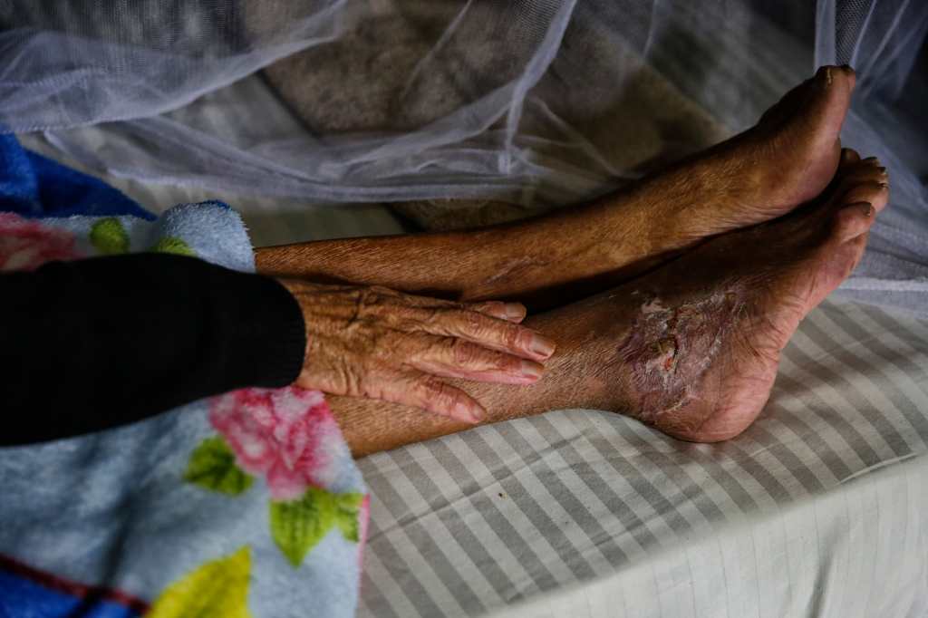 Cristina Henríquez Funes muestra las secuelas en su piel por la infestación de gusano barrenador durante una entrevista en Lepaterique, Honduras.