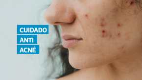 El acné es una enfermedad inflamatoria de la piel que suele aparecer en rostro, pecho y espalda, y puede impactar la autoestima de adolescentes y adultos. Según las dermatólogas Miriam Yat y Eva Oliva, la higiene adecuada, el uso de protector solar y tratamientos prescritos por especialistas son claves para controlar esta afección y evitar secuelas permanentes.