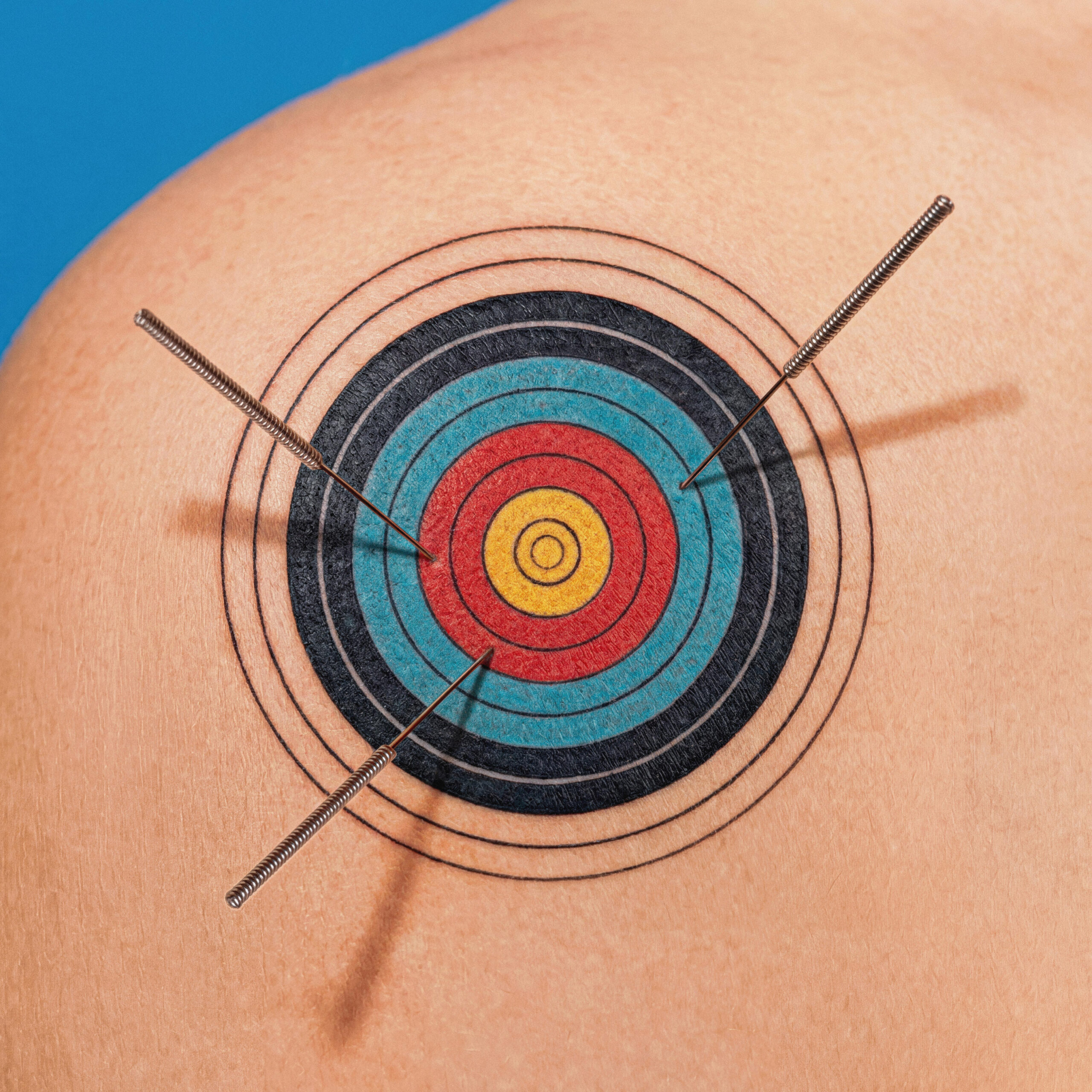 Having tiny needles poked into a painful muscle knot is unnerving. But can it help? (Javier Jan/The New York Times)  Ñ FOR EDITORIAL USE ONLY WITH NYT STORY SLUGGED SCI DRY NEEDLING BY ANDREA JAVOR FOR APRIL 20, 2026. ALL OTHER USE PROHIBITED. Ñ